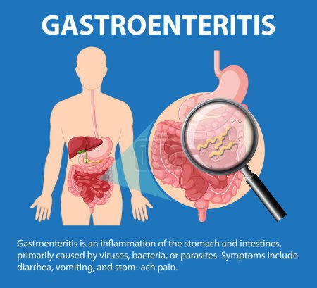 Ilustración de Una infografía que ilustra las causas y síntomas de la gastroenteritis - Imagen libre de derechos