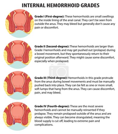 Illustration for Learn about the different grades of internal hemorrhoids in this educational infographic - Royalty Free Image