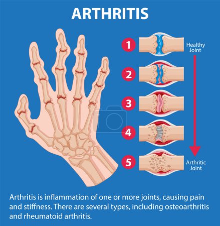 Téléchargez les illustrations : Infographie illustrant les stades de l'arthrite dans la main humaine - en licence libre de droit