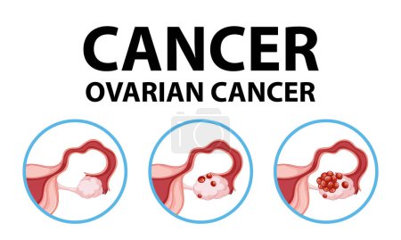 Illustration for Illustrated infographic highlighting the medical anatomy of ovarian cancer in women - Royalty Free Image