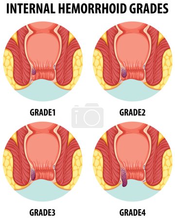 Illustration for Detailed cartoon illustration showing various grades of internal hemorrhoids - Royalty Free Image