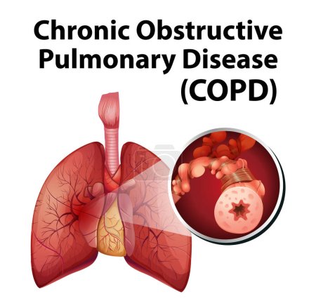 Photo for Illustrated infographic explaining chronic obstructive pulmonary disease in human anatomy - Royalty Free Image