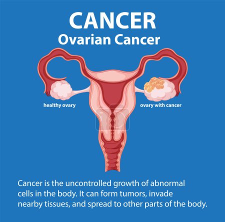 Illustration for Illustration highlighting differences between healthy and cancerous ovaries - Royalty Free Image