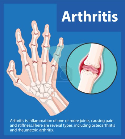 Téléchargez les photos : Apprenez-en plus sur les étapes de l'arthrite grâce à une infographie d'éducation scientifique - en image libre de droit