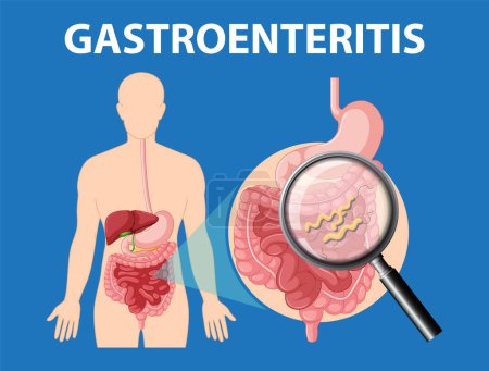 Illustration for Illustration depicting gastroenteritis, its causes, and associated symptoms - Royalty Free Image