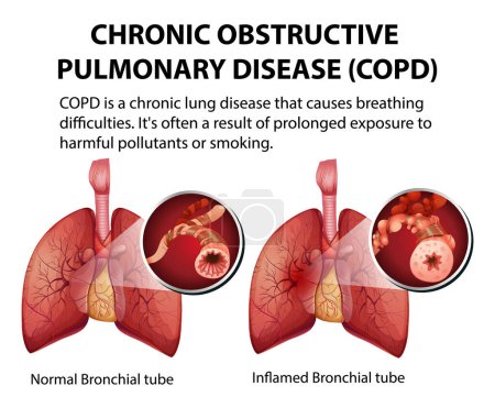 Ilustración de Infografía ilustrada que explica la enfermedad pulmonar obstructiva crónica en la anatomía humana - Imagen libre de derechos