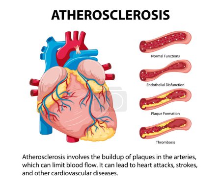 Ilustración de Aprenda sobre la salud y la enfermedad del corazón a través de una infografía informativa - Imagen libre de derechos
