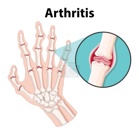 Illustration for Learn about human anatomy and arthritis stages through a science education infographic - Royalty Free Image