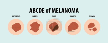 Ilustración de Aprenda sobre diferentes tipos de cáncer de piel a través de ilustraciones vectoriales - Imagen libre de derechos