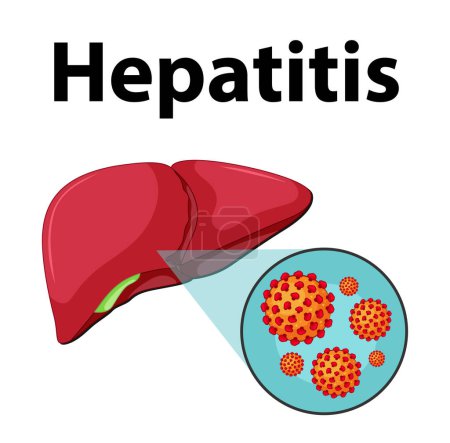 Illustration for Detailed illustration of hepatitis virus cell on human liver - Royalty Free Image