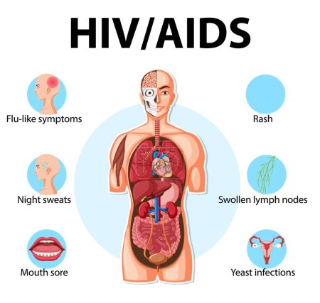 Illustration for Illustrated infographic depicting the impact of HIV/AIDS on the body's immune system - Royalty Free Image