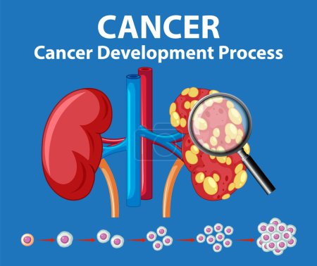 Illustration for Illustrated infographic depicting the process of cancer development on the human kidney - Royalty Free Image