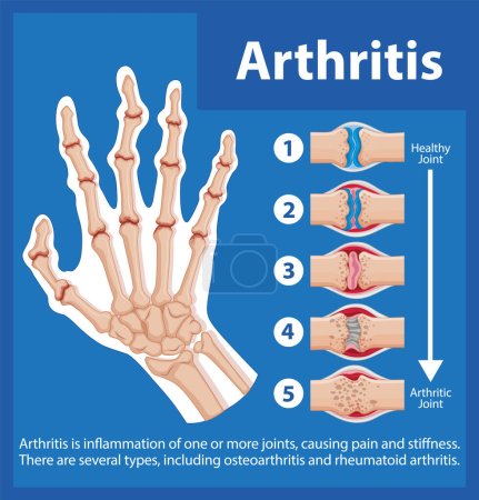 Téléchargez les illustrations : Infographie illustrée montrant les étapes de l'arthrite dans la main humaine - en licence libre de droit