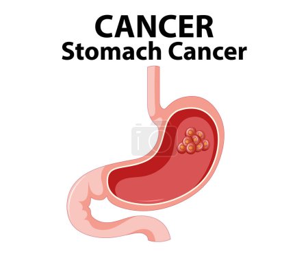 Illustration for Detailed cartoon-style illustration depicting the anatomy of stomach cancer - Royalty Free Image