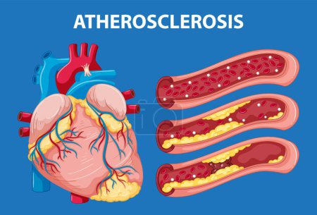 Ilustración al estilo de dibujos animados que explica la anatomía del corazón y el desarrollo de la aterosclerosis