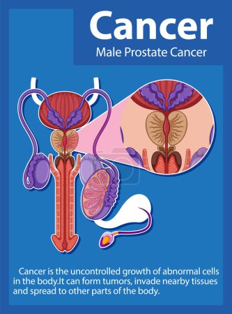 Ilustración de Infografía que ilustra las diferencias entre las células prostáticas normales y cancerosas - Imagen libre de derechos