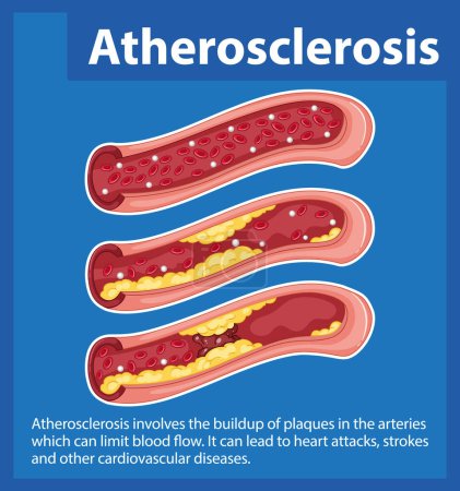 Ilustración de Aprenda sobre la salud del corazón y el desarrollo de la aterosclerosis a través de una infografía educativa - Imagen libre de derechos