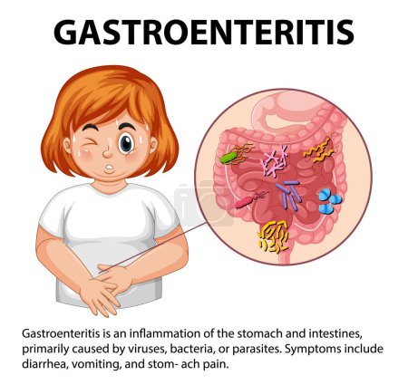 Ilustración de Ilustración que representa los síntomas de gastroenteritis en una mujer gordita - Imagen libre de derechos