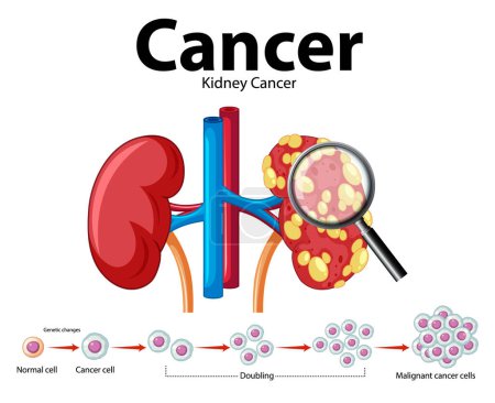 Ilustración de Ilustración que muestra el crecimiento celular anormal y la progresión del cáncer en el riñón humano - Imagen libre de derechos
