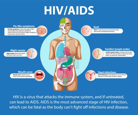 Ilustración de Ilustración que muestra los efectos del VIH / SIDA en el cerebro, la boca, la piel y los síntomas - Imagen libre de derechos