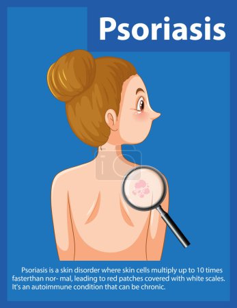 Illustration for An infographic illustrating the medical anatomy of women with psoriasis - Royalty Free Image