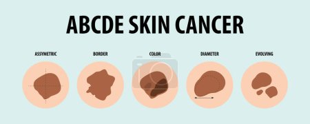 Illustration for Learn about different types of skin cancer through vector illustrations - Royalty Free Image