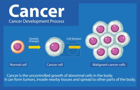 Ilustración de Conocer el desarrollo y la progresión de las células cancerosas mediante una infografía informativa - Imagen libre de derechos