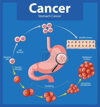 Ilustración de Infografía ilustrada que muestra el crecimiento anormal de las células en el cáncer de estómago - Imagen libre de derechos