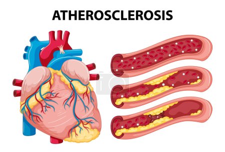 Cartoon illustration explaining heart anatomy and atherosclerosis development