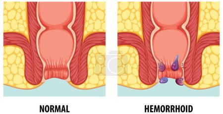 Illustration for Illustration comparing normal anatomy with hemorrhoids in humans - Royalty Free Image