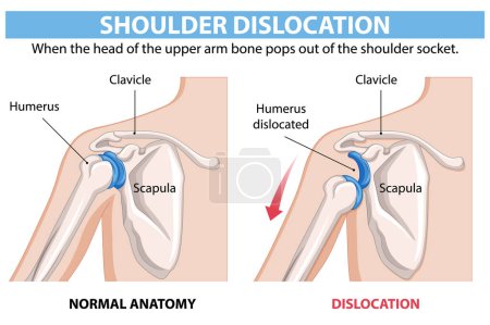 Comparación de la anatomía normal y dislocada del hombro