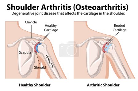 Ilustración de Diagrama de articulación del hombro saludable vs. artrítico - Imagen libre de derechos