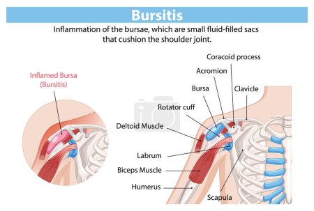 Ilustración de Anatomía detallada de la inflamación bursitis hombro - Imagen libre de derechos