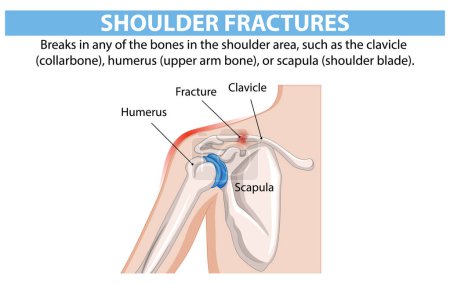 Diagram of shoulder fractures and affected bones