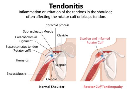 Ilustración de Inflamación de los tendones del hombro, manguito rotador - Imagen libre de derechos