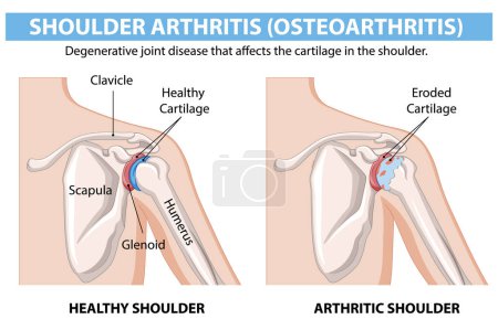 Diagrama de articulación del hombro saludable vs. artrítico