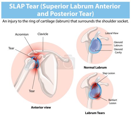 Detailed diagram of shoulder labrum tears