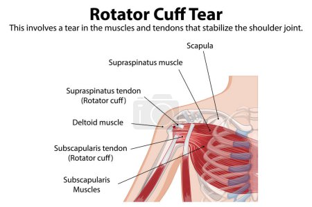 Detailed anatomy of shoulder muscle tear