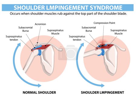 Illustration for Comparison of normal shoulder and shoulder impingement - Royalty Free Image