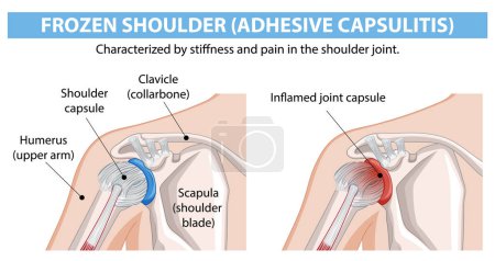 Illustration for Diagram showing frozen shoulder anatomy and inflammation - Royalty Free Image