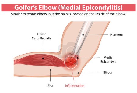 Illustration for Detailed diagram of medial epicondylitis in the elbow - Royalty Free Image