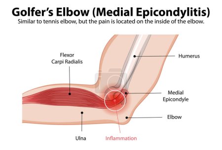 Illustration for Detailed diagram of medial epicondylitis in the elbow - Royalty Free Image