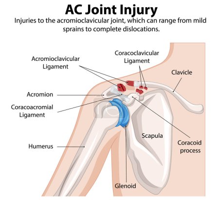 Ilustración detallada de la anatomía y lesiones de las articulaciones del hombro