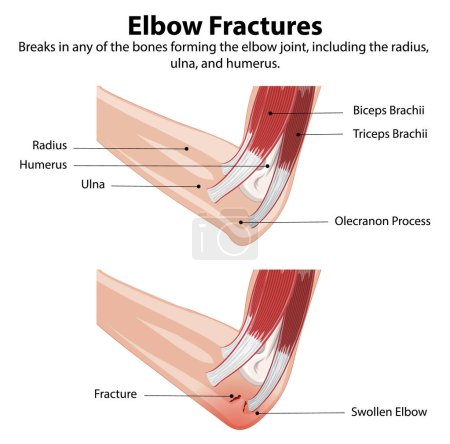 Diagrama que muestra los tipos de fracturas de codo