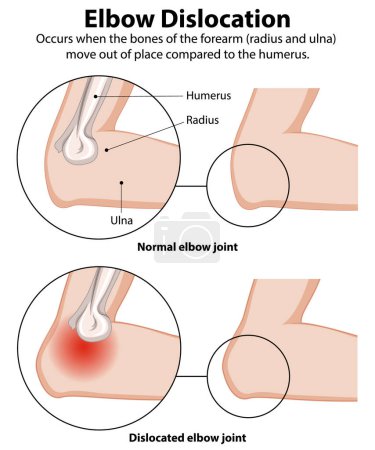 Comparison of normal and dislocated elbow joints