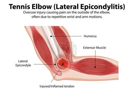 Téléchargez les illustrations : Detailed diagram of tennis elbow condition - en licence libre de droit
