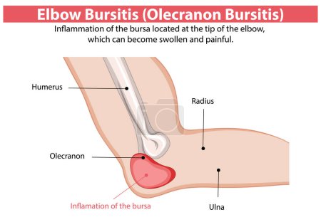 Inflammation of the elbow bursa causing pain