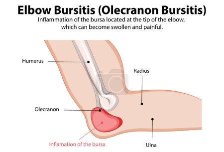 Depicts inflammation of the elbow bursa