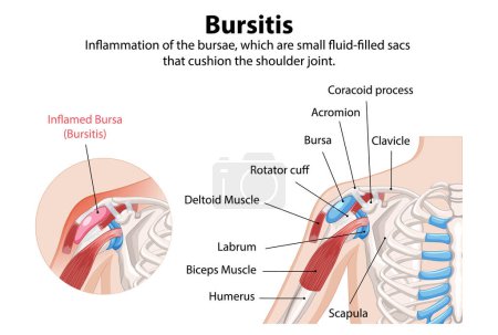 Illustration of shoulder bursitis and anatomy