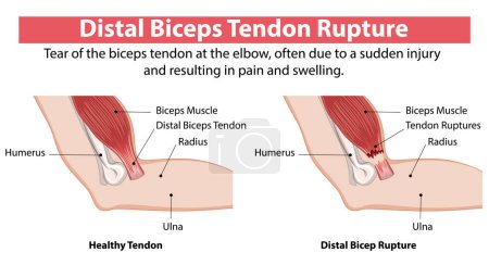 Comparison of healthy and ruptured biceps tendon